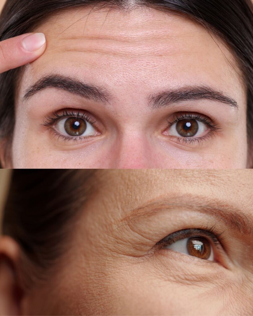 botox